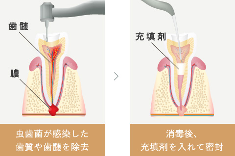 虫歯菌が感染した歯質や歯髄を除去、消毒後充填剤を入れて密封