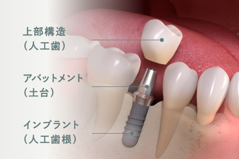 上部構造（人工歯）、アバットメント（土台）、インプラント（人工歯根）