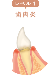 レベル1：歯肉炎