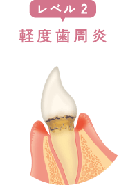 レベル2：軽度歯周炎